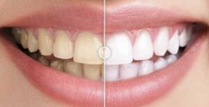 Before & After Images Comparison WordPress Plugin GPL
